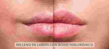 Como hidratar los labios después de ácido hialurónico