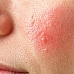 Piel reactiva: qué es, causas, síntomas y cómo calmarla
