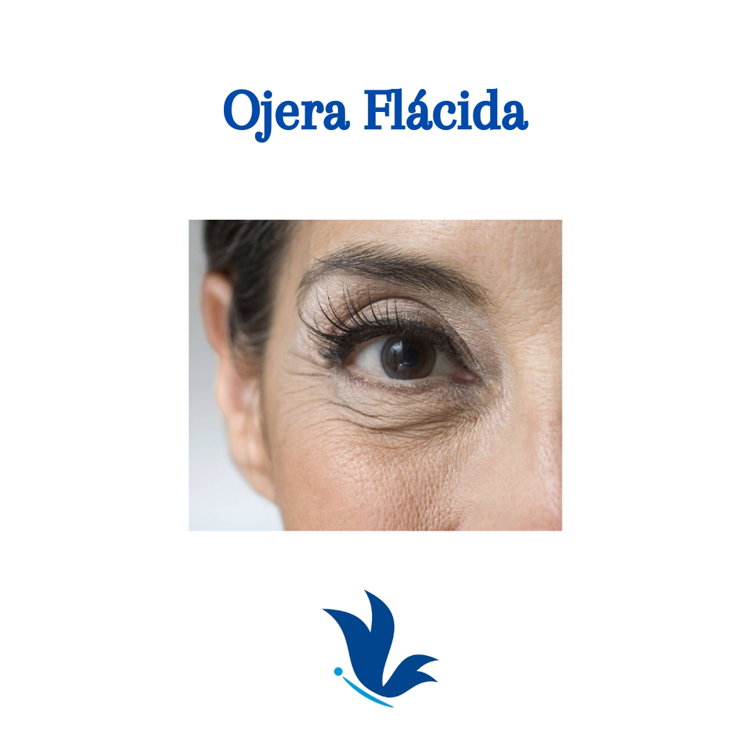 Ojera Flácida