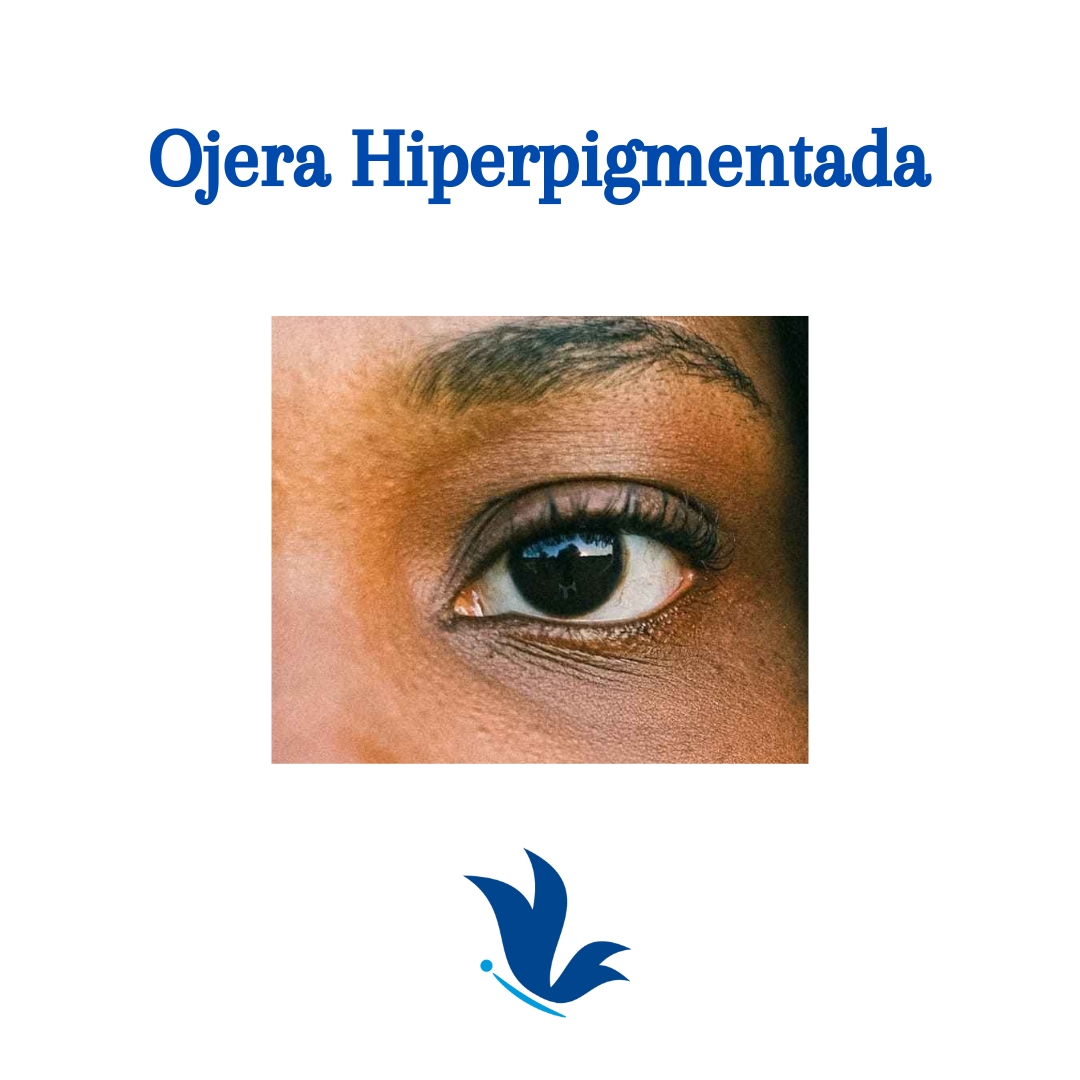 Ojera Hiperpigmentación