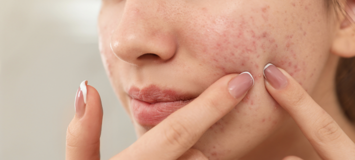 Piel con acné y puntos negros