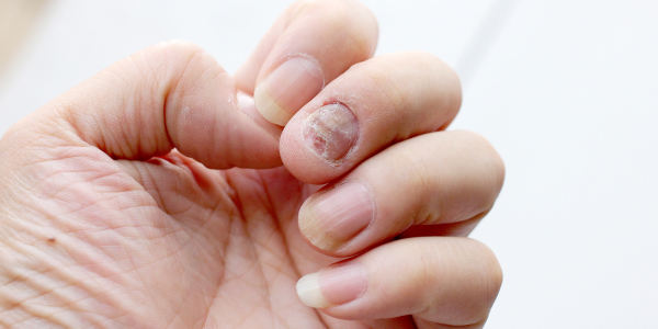 Uñas con psoriasis