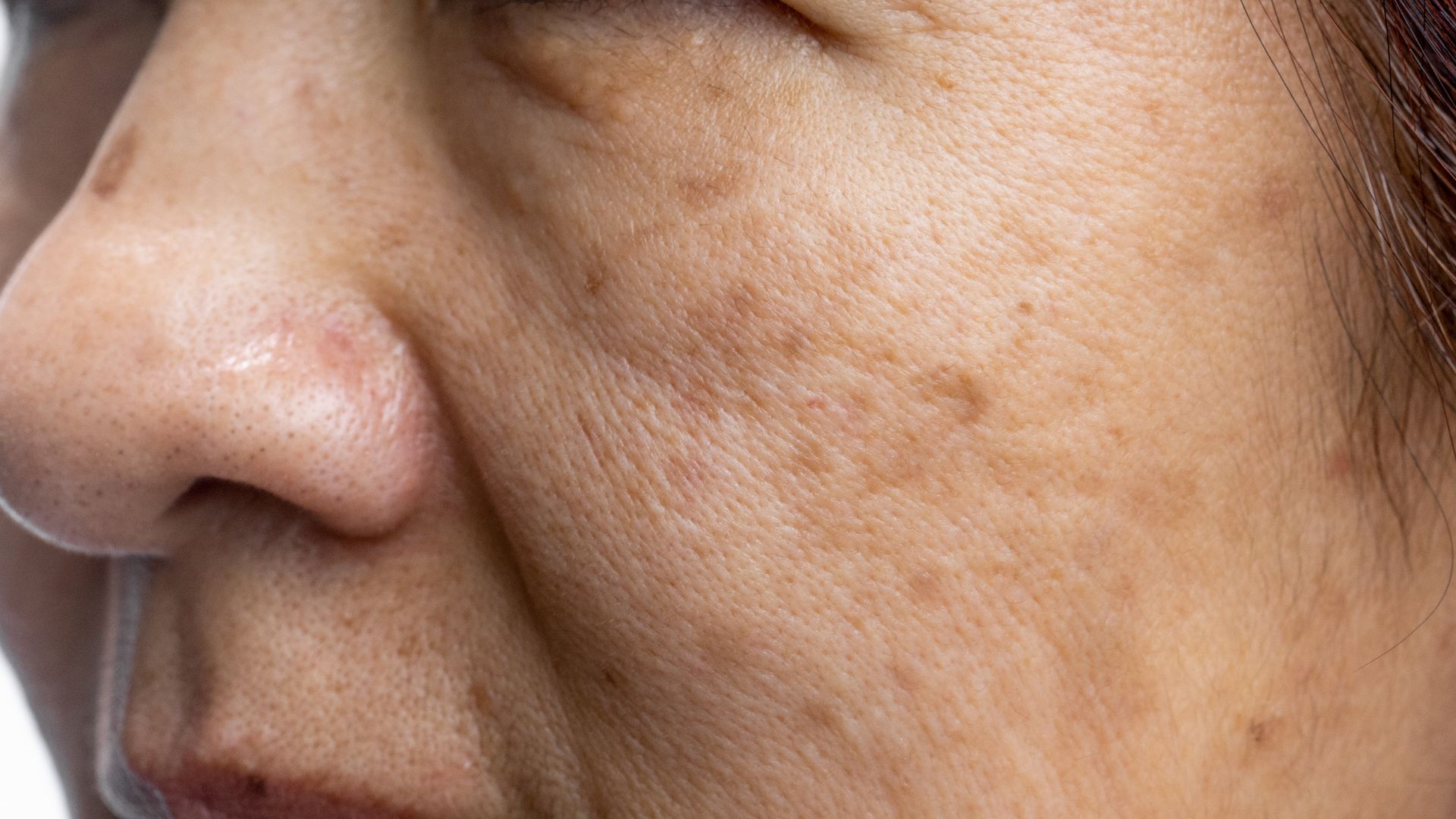 Mujer con manchas de melasma en la cara