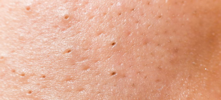 Qué son los puntos negros y por qué aparecen